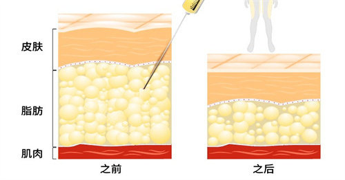 吸脂手术前后