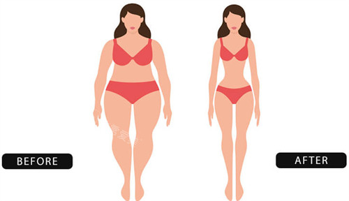 埋线减肥前后对比