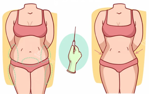 埋线吸脂前后对比