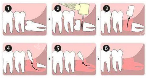 牙科拔牙过程图片