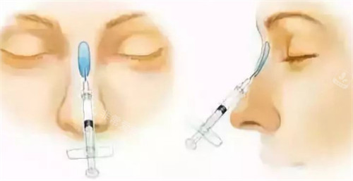 注射隆鼻过程图解
