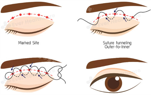 埋线双眼皮图