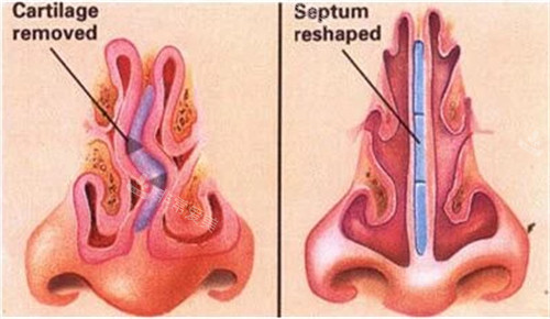 歪鼻情况下鼻背的样子图解