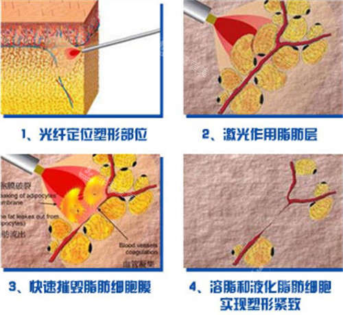 光纖溶脂的原理圖解 光纖溶脂的原理圖解
