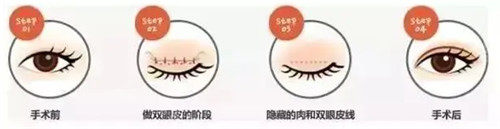双眼皮手术方式图