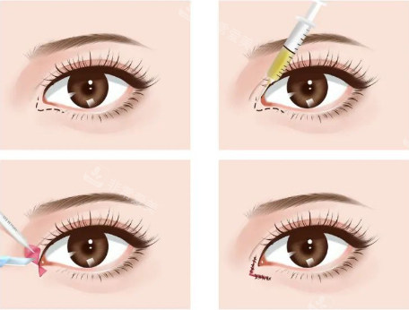 眼角手术细节动画图