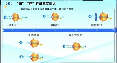 奥拉怒放离焦防控镜片佩戴过程原理