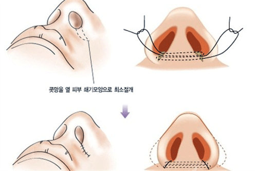 隆鼻手术不同切口位置图解