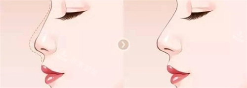隆鼻动画图