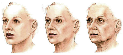 面部提升手术前后对比