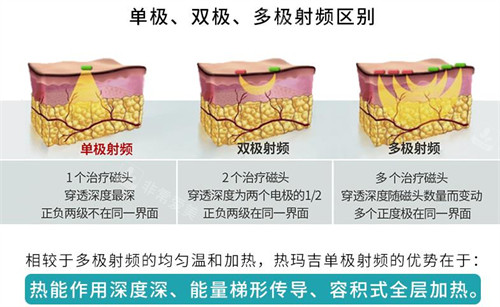 熱瑪吉在皮膚進(jìn)行工作的區(qū)別