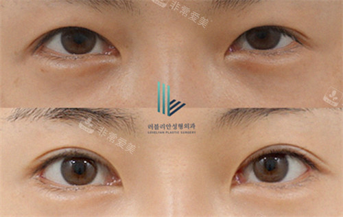 韩国乐于丽颜整形外科双眼皮手术前后对比图