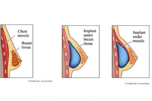 植入假體隆胸后的樣子圖解