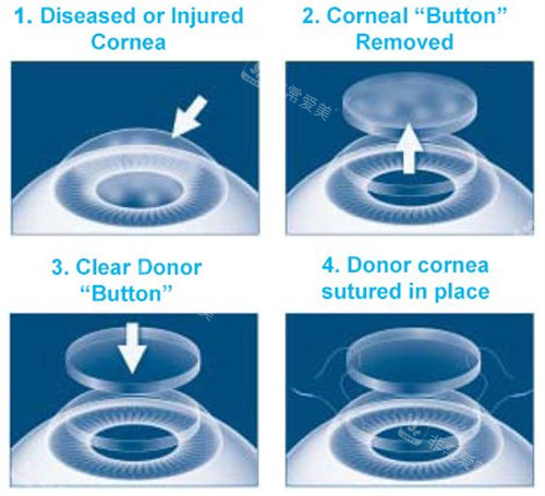 角膜移植过程图