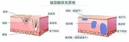 玻尿酸填充原理