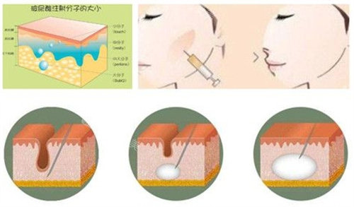 玻尿酸填充過(guò)程圖 玻尿酸填充過(guò)程圖