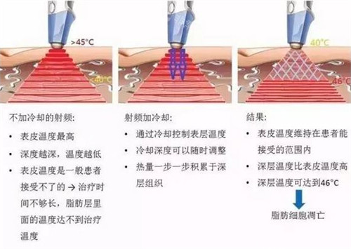 溶脂刀仪器施术过程图解