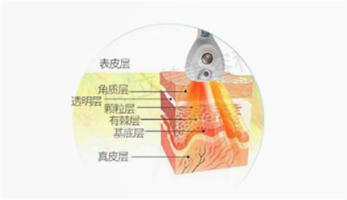 溶脂刀仪器可以深入到的层次图解