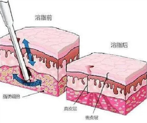 火凤凰溶脂前后对比图