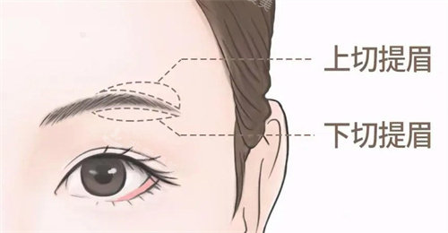 提眉手术不同切口
