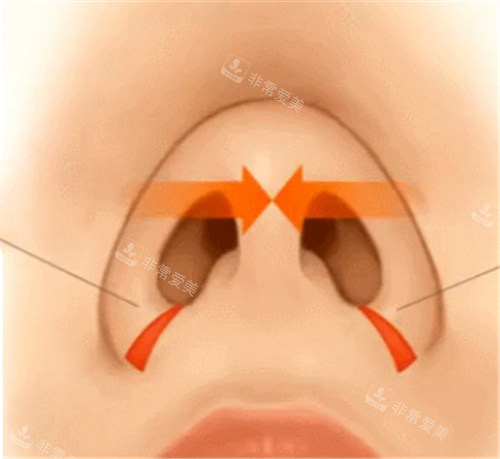 鼻翼缩小演示图