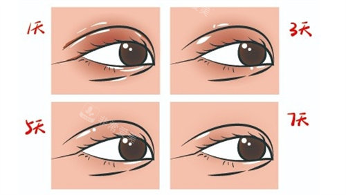 双眼皮动画图