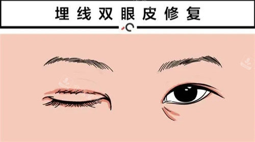 双眼皮修复动画图