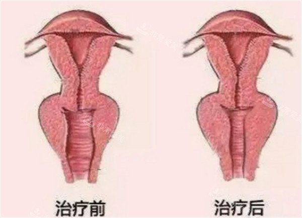 3D生物束带紧缩术术前术后对比图