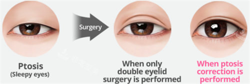 双眼皮术后恢复过程图解