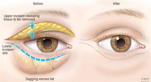 中年眼综合整形前后对比图
