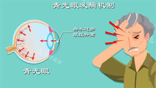 青光眼的发病机制图解