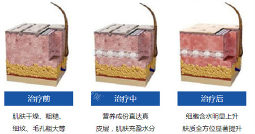 水光类针剂改善皮肤前后对比