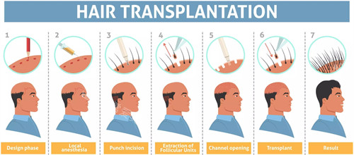 头发种植过程图