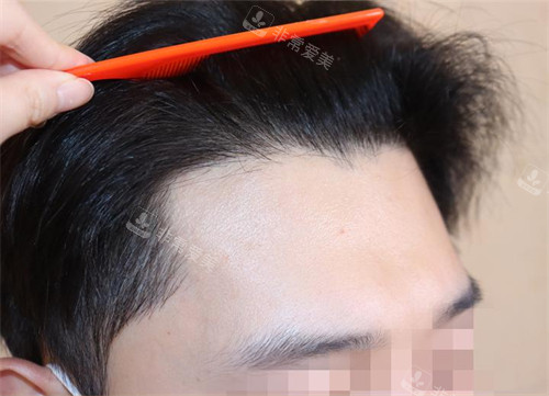 韩国永长植发医院发际线植发后