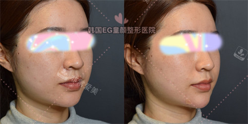 韓國eg童顏整形下巴填充前后對比圖