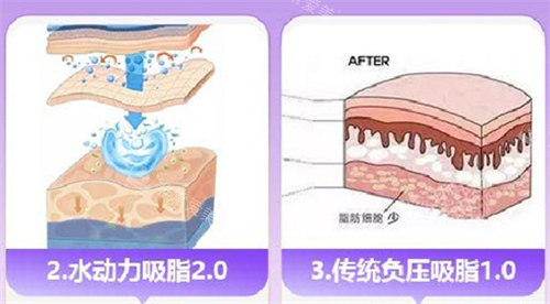 水动力吸脂和传统吸脂对比