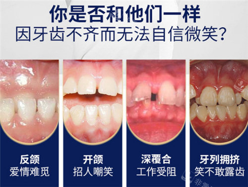 牙齿不齐的几种情况
