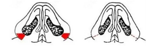鼻翼缩小动画图