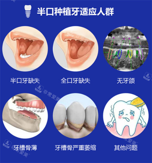 半口种植牙适应人群
