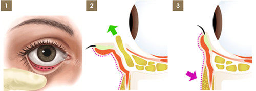 眼袋手術(shù)圖解