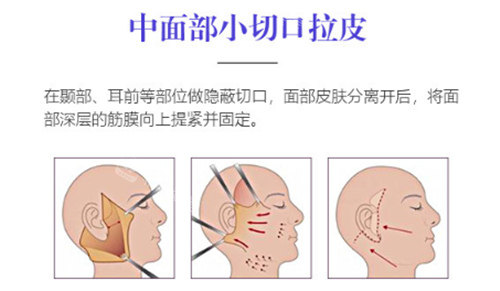 中面部小切口拉皮原理