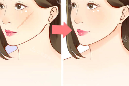 面部疤痕祛除前后对比图