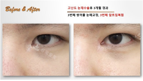 韩国SONE整形外科眼修复术前术后对比图