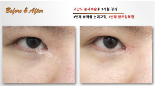 韩国SONE整形外科眼修复术前术后对比图