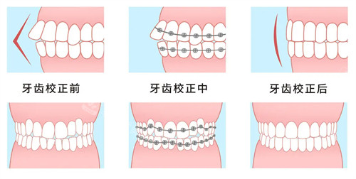 金属自锁牙齿矫治器佩戴过程图