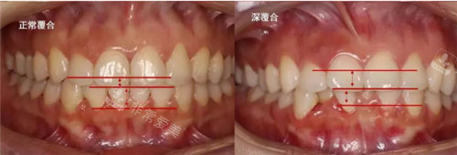 深覆合跟正常覆合