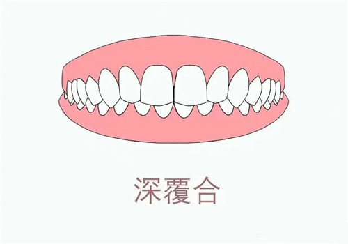 深覆合图示