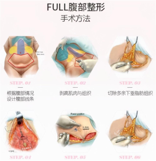 腹壁成形术手术过程图解