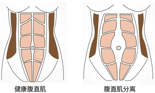 腹壁成形术前后腹直肌的变化图解