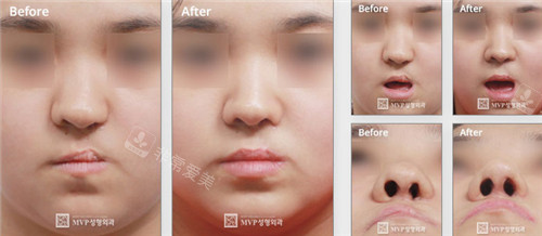 崔宇植坐诊在韩国Noselips整形外科,擅长做唇腭裂修复,可在线预约挂号!